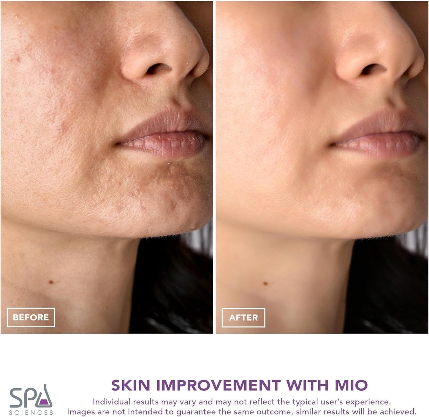 Spa Sciences - MIO - Diamond Tip Microdermabrasion Blackhead Remover, Pore Cleansing, & Resurfacing System - Reduces Acne Scars, Wrinkles, and Exfoliates for Clearer Skin