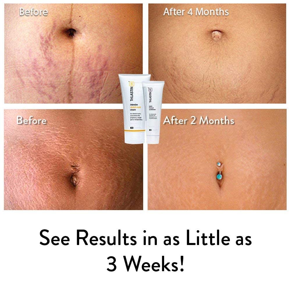 TriLASTIN-SR Intensive Stretch Mark Cream Bundle with Hydro-Thermal Accelerator (5.5 & 3 oz) | Fast-Acting Stretch Marks Cream with Absorption Enhancing Serum | Hypoallergenic & Paraben-free