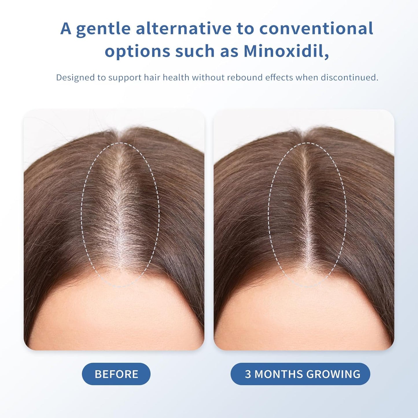 Hair Growth Serum Roll-On 30ml | Patented Blend with 3% Rosemary, 3% Redensyl, 2% AnaGain, Biotin & Niacinamide | No-Rinse, Fast-Absorbing | For Thinning Hair & All Hair Types (1.01 Fl Oz (Pack of 1))