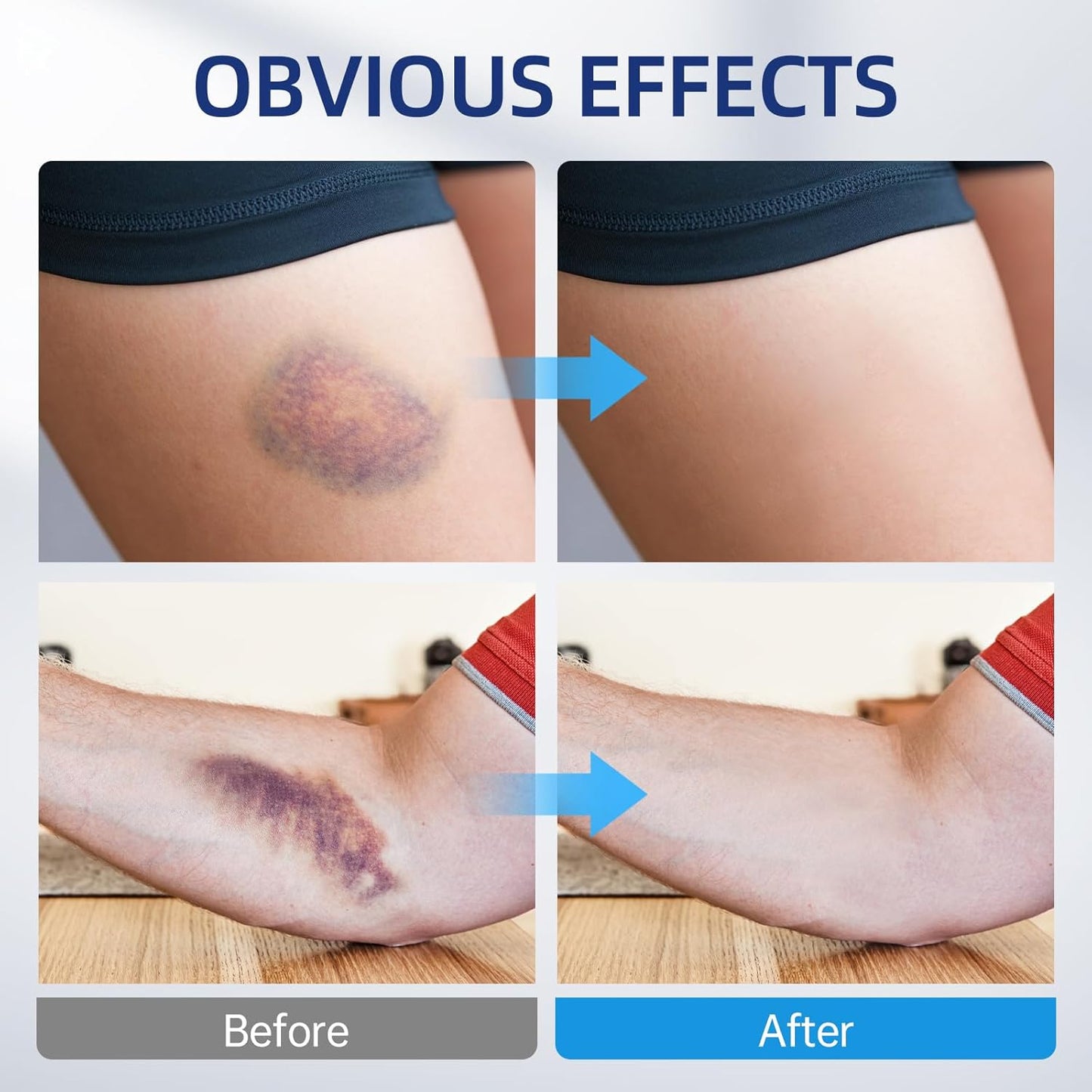 Arnica Bruise Cream Extra Strength-Fast Healing for Bruising & Swelling on Thin Skin, Arnica Gel with Vitamins K, C & E for Hydrating, Natural Pain Cream for Face & Body, 4 oz