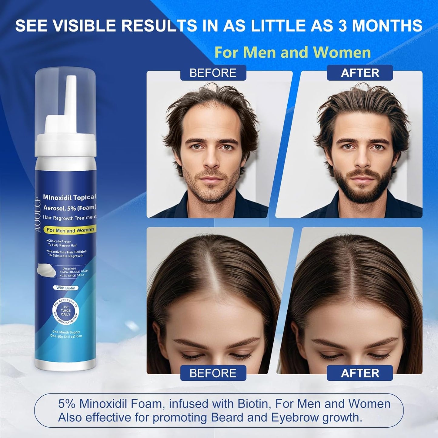 5% Topical Minoxidil Foam, Minoxidil for Men and Women, Infused with Biotin, Hair Growth Treatment, Supports Thicker and Fuller Hair & Beard (Minoxidil Foam, 6.33oz, 3 Month Supply)