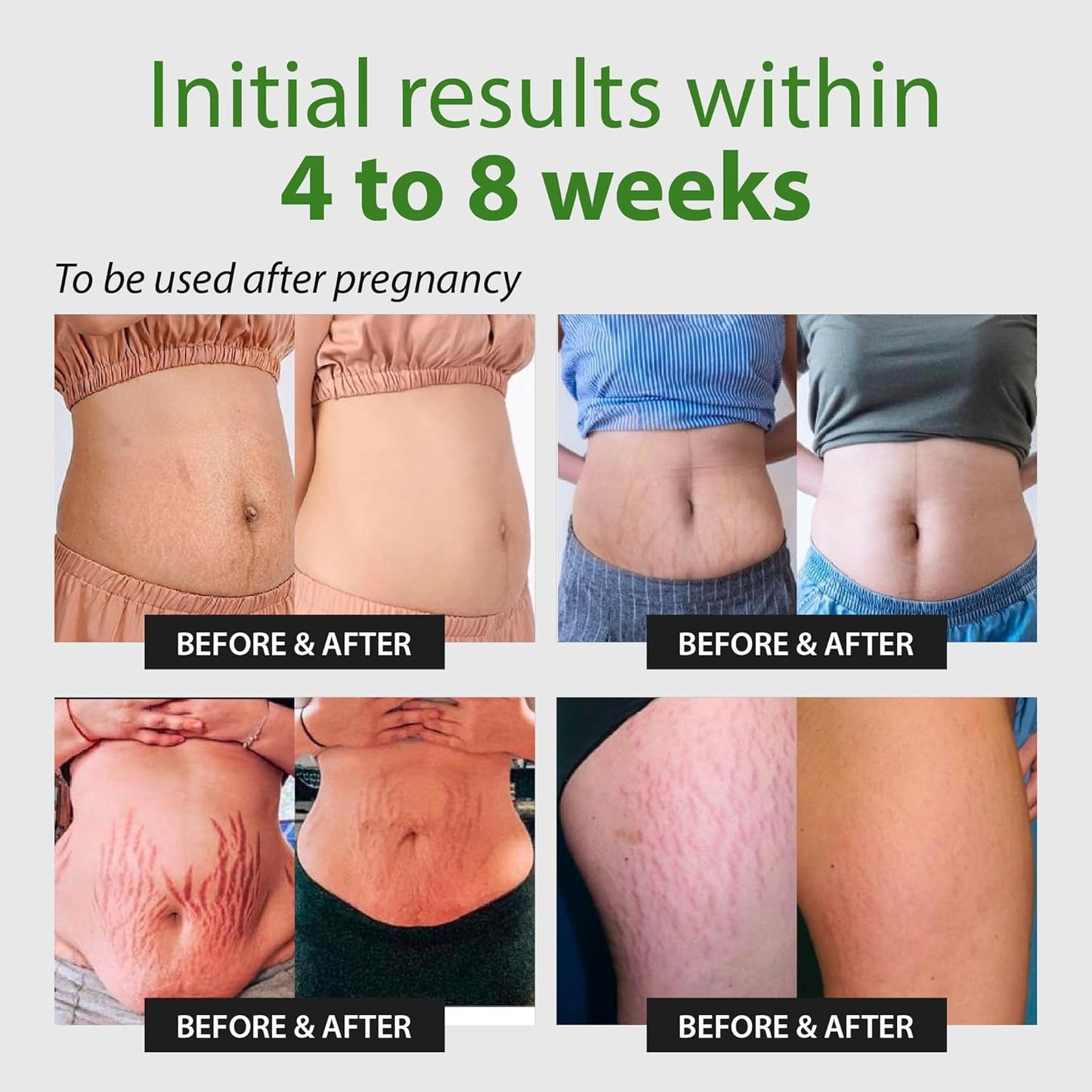 Abera Ovela Stretch Mark Cream, Stretch Marks Treatment For Pregnancy and Weight Fluctuations, Effective Treatment for Stretchmarks in All Skin Types (A. 1 Box + Ice Roller)